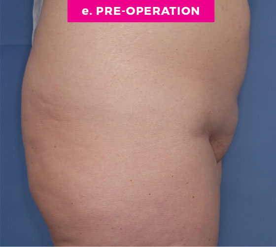 Pubic Liposuction Patient 6 Before 3