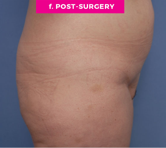 Pubic Liposuction Patient 6 After 3