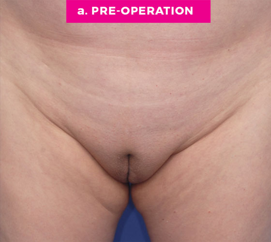 Pubic Liposuction Patient 7 Before