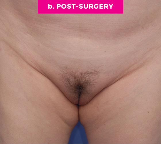 Pubic Liposuction Patient 7 After