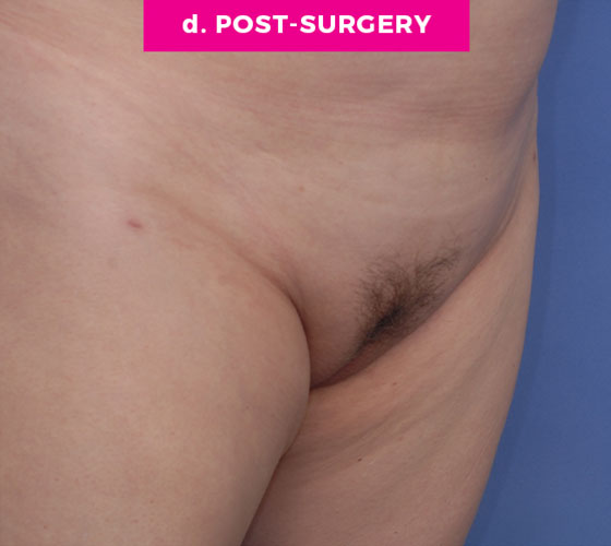 Pubic Liposuction Patient 7 After 2