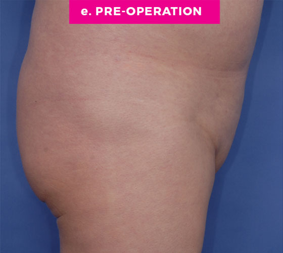 Pubic Liposuction Patient 7 Before 3