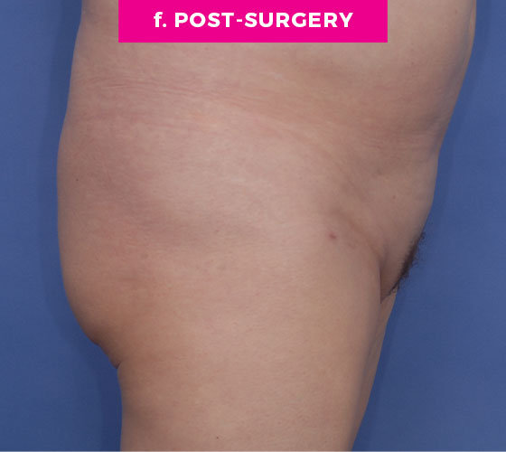 Pubic Liposuction Patient 7 After 3