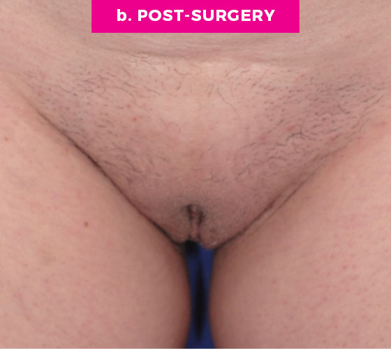 Pubic Liposuction Patient 8 After