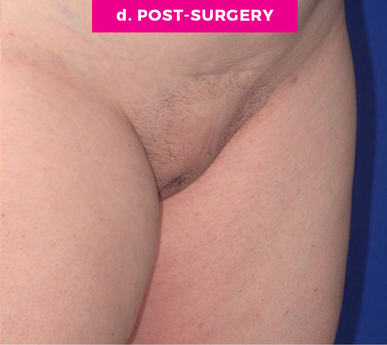 Pubic Liposuction Patient 8 After 2
