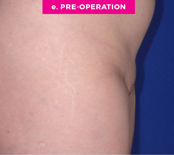 Pubic Liposuction Patient 8 Before 3