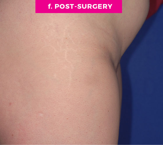 Pubic Liposuction Patient 8 After 3