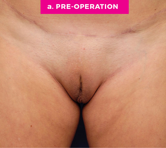 Pubic Liposuction Patient 9 Before