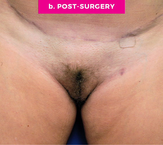 Pubic Liposuction Patient 9 After