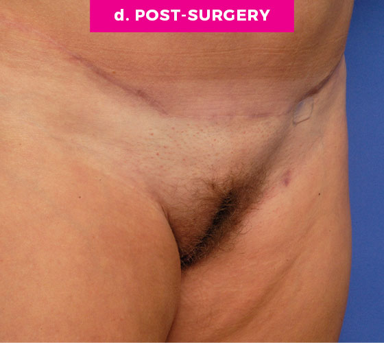 Pubic Liposuction Patient 9 After 2