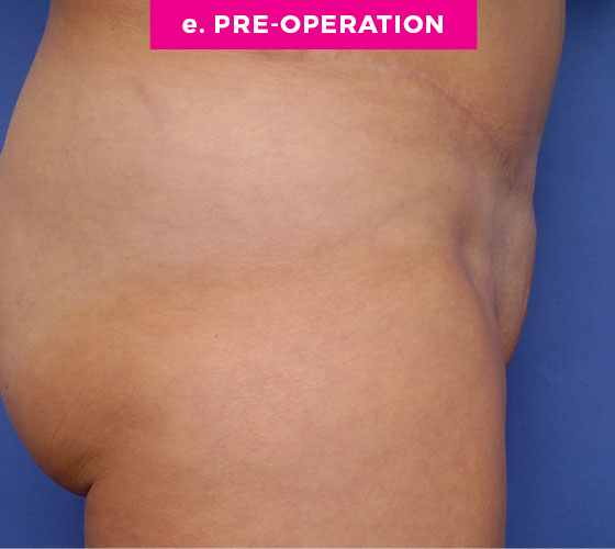 Pubic Liposuction Patient 9 Before 3