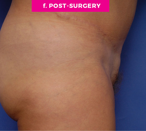 Pubic Liposuction Patient 9 After 3