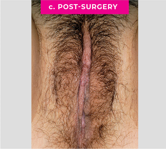 REVISION OF BOTCHED LABIAPLASTIES Patient 1 Before 2