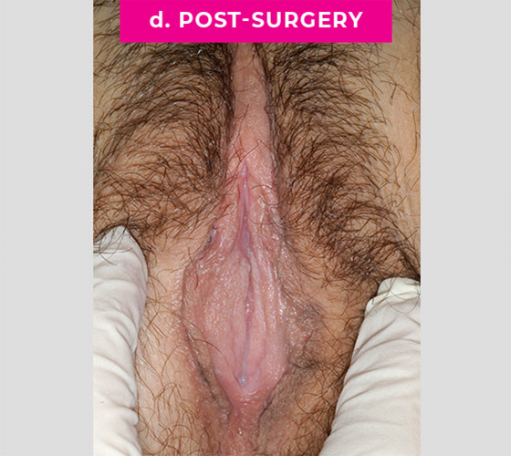 REVISION OF BOTCHED LABIAPLASTIES Patient 1 After 2