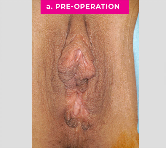 REVISION OF BOTCHED LABIAPLASTIES Patient 2 Before