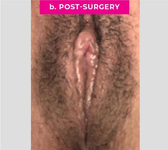 REVISION OF BOTCHED LABIAPLASTIES Patient 20 After