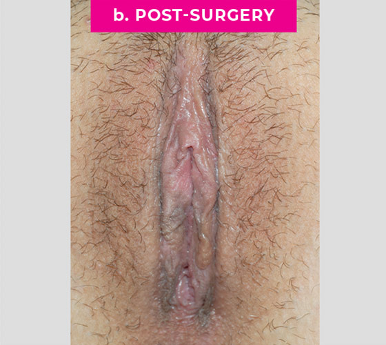 REVISION OF BOTCHED LABIAPLASTIES Patient 21 After