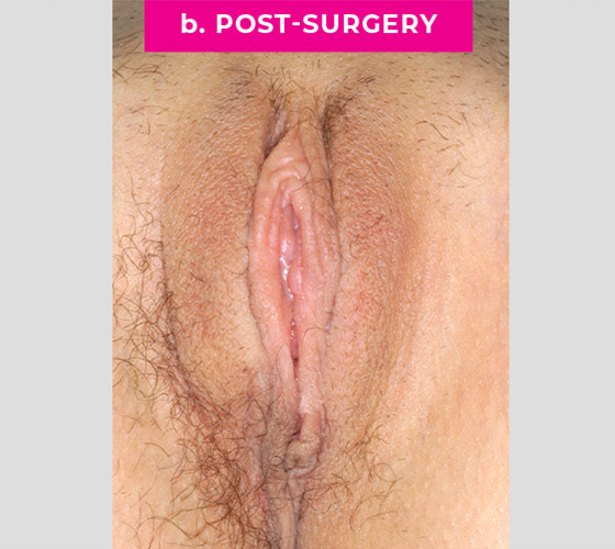 REVISION OF BOTCHED LABIAPLASTIES Patient 3 After