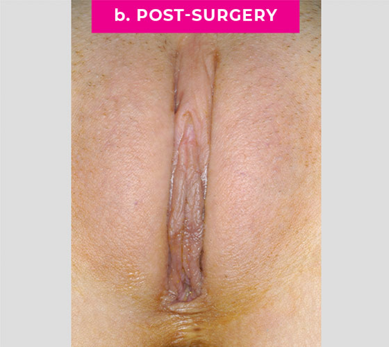 REVISION OF BOTCHED LABIAPLASTIES Patient 5 After