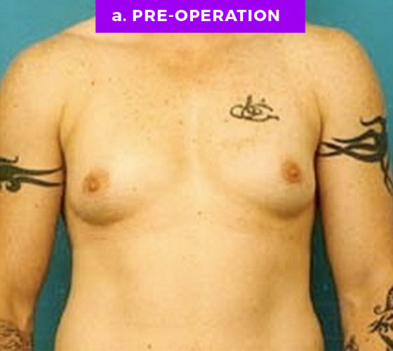 FEMALE-TO-MALE CHEST CONTOURING Patient 1 Before