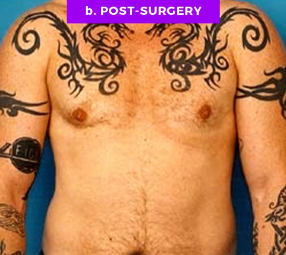 FEMALE-TO-MALE CHEST CONTOURING Patient 1 After