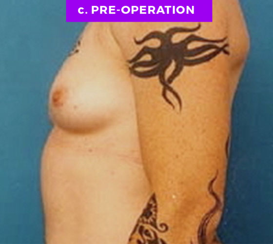 FEMALE-TO-MALE CHEST CONTOURING Patient 1 Before 2