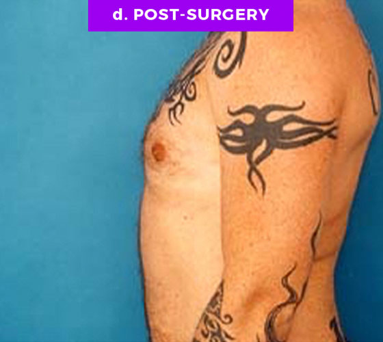 FEMALE-TO-MALE CHEST CONTOURING Patient 1 After 2