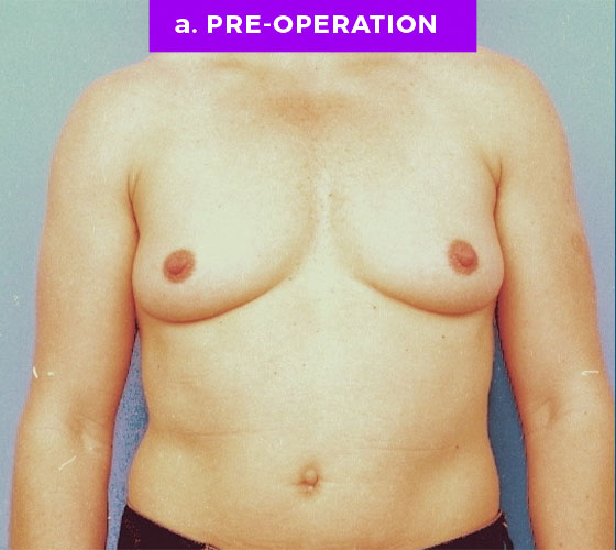 FEMALE-TO-MALE CHEST CONTOURING Patient 2 Before