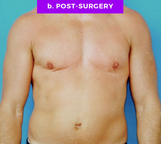 FEMALE-TO-MALE CHEST CONTOURING Patient 2 After