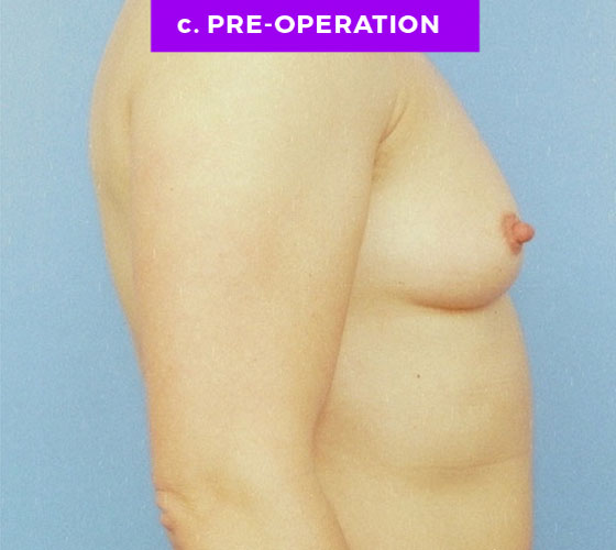 FEMALE-TO-MALE CHEST CONTOURING Patient 2 Before 2