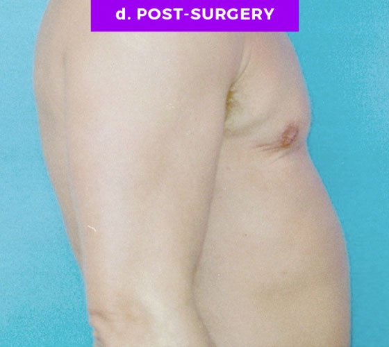 FEMALE-TO-MALE CHEST CONTOURING Patient 2 After 2