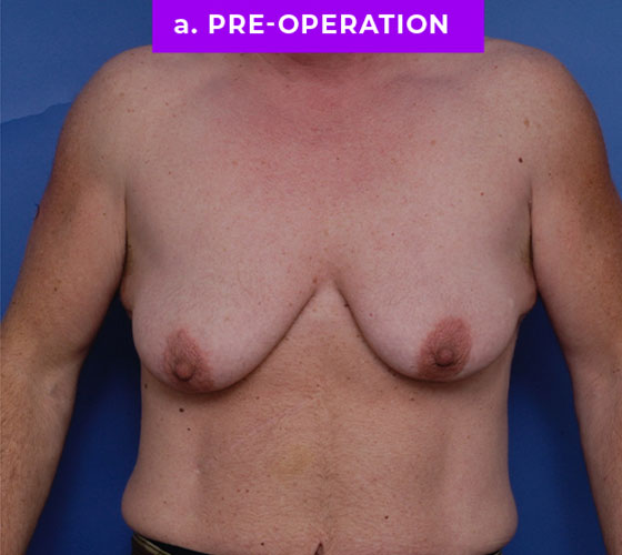 FEMALE-TO-MALE CHEST CONTOURING Patient 32 Before