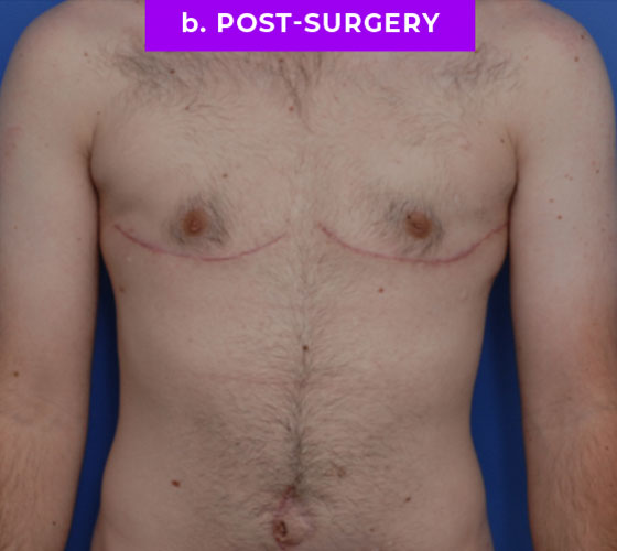 FEMALE-TO-MALE CHEST CONTOURING Patient 33 After