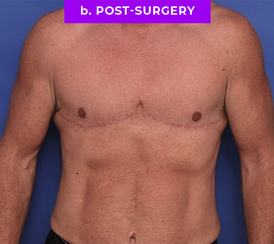 FEMALE-TO-MALE CHEST CONTOURING Patient 32 After