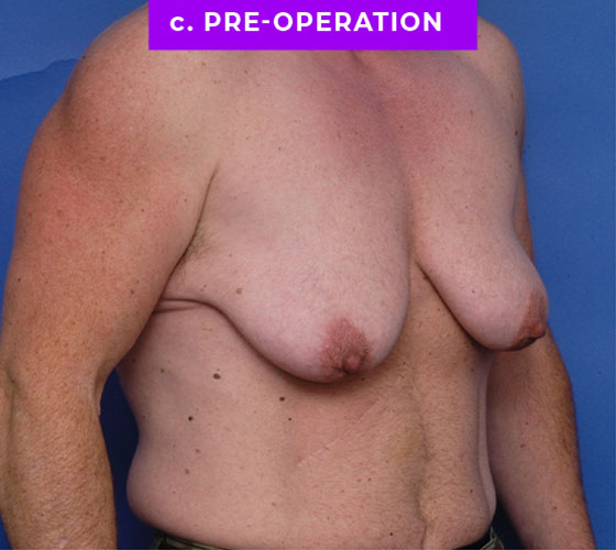 FEMALE-TO-MALE CHEST CONTOURING Patient 32 Before 2