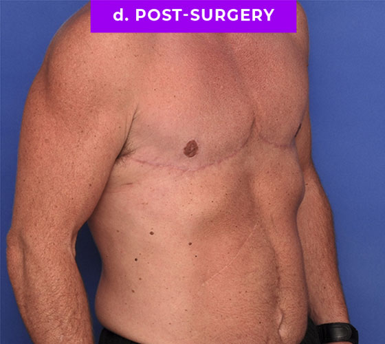 FEMALE-TO-MALE CHEST CONTOURING Patient 32 After 2