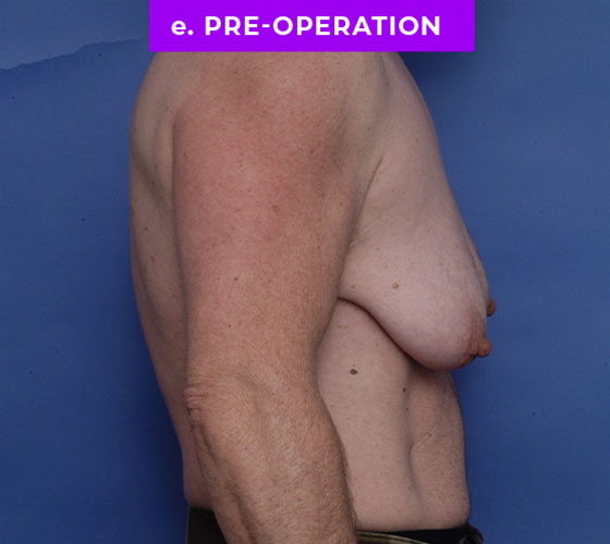FEMALE-TO-MALE CHEST CONTOURING Patient 32 Before 3