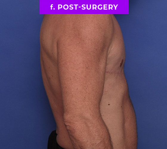 FEMALE-TO-MALE CHEST CONTOURING Patient 32 After 3