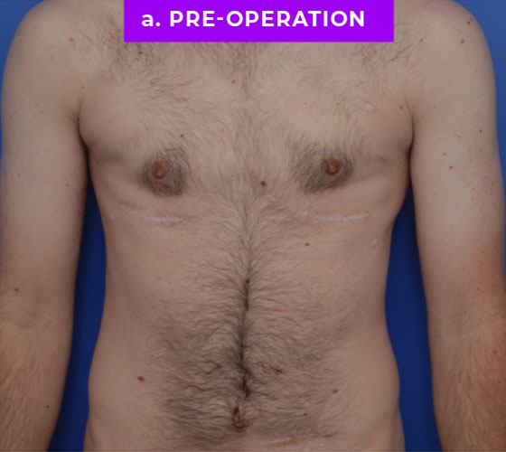 FEMALE-TO-MALE CHEST CONTOURING Patient 33 Before