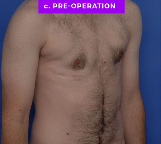 FEMALE-TO-MALE CHEST CONTOURING Patient 33 Before 2