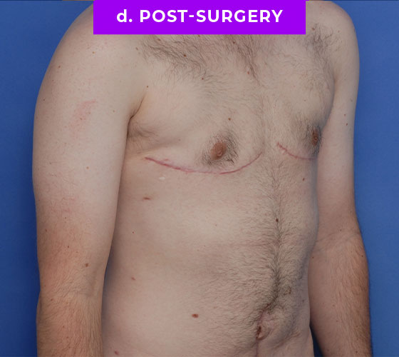 FEMALE-TO-MALE CHEST CONTOURING Patient 33 After 2