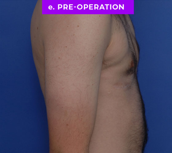 FEMALE-TO-MALE CHEST CONTOURING Patient 33 Before 3