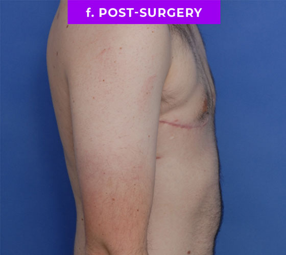 FEMALE-TO-MALE CHEST CONTOURING Patient 33 After 3