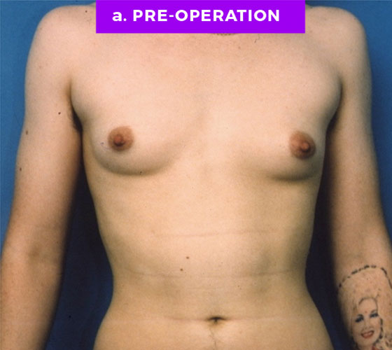 FEMALE-TO-MALE CHEST CONTOURING Patient 3 Before