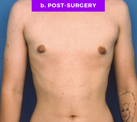 FEMALE-TO-MALE CHEST CONTOURING Patient 3 After
