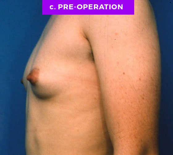 FEMALE-TO-MALE CHEST CONTOURING Patient 3 Before 2