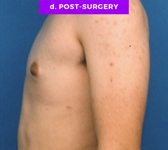 FEMALE-TO-MALE CHEST CONTOURING Patient 3 After 2