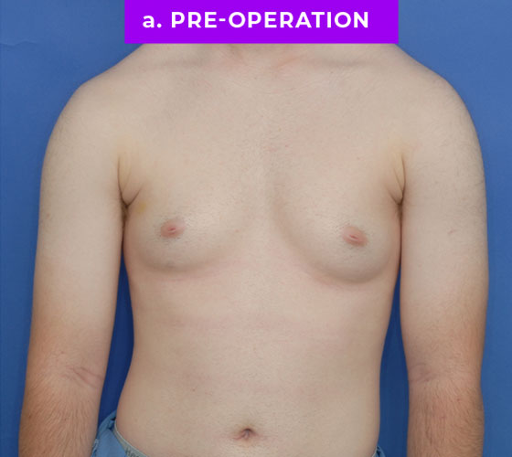 FEMALE-TO-MALE CHEST CONTOURING Patient 10 Before
