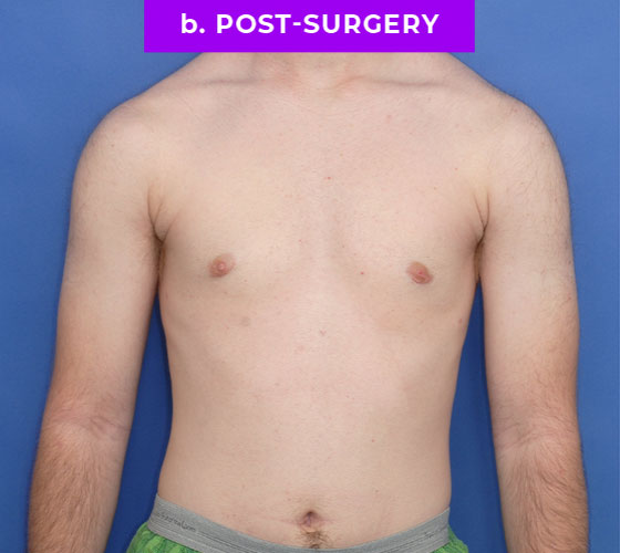 FEMALE-TO-MALE CHEST CONTOURING Patient 10 After