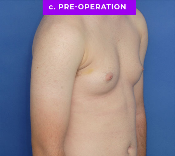 FEMALE-TO-MALE CHEST CONTOURING Patient 10 Before 2